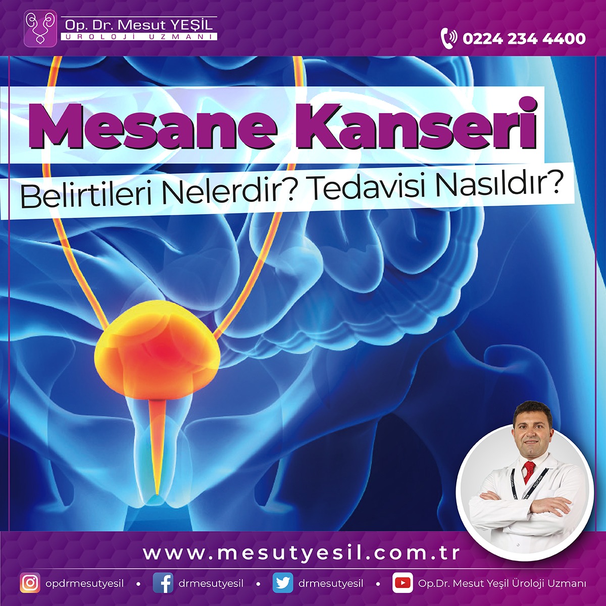 Mesane Kanseri Nedir? Belirtileri ve Tedavi Yöntemleri Nelerdir Mesane Kanseri Nedir? Belirtileri ve Tedavi Yöntemleri Nelerdir