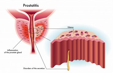 Prostatit - Prostat İltihabı Nedir ?