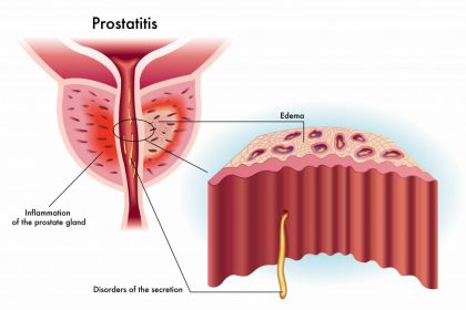 Prostatit - Prostat İltihabı Nedir ?
