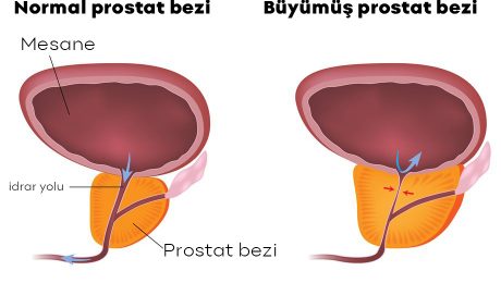 İyi Huylu Prostat Büyümesi (BPH)