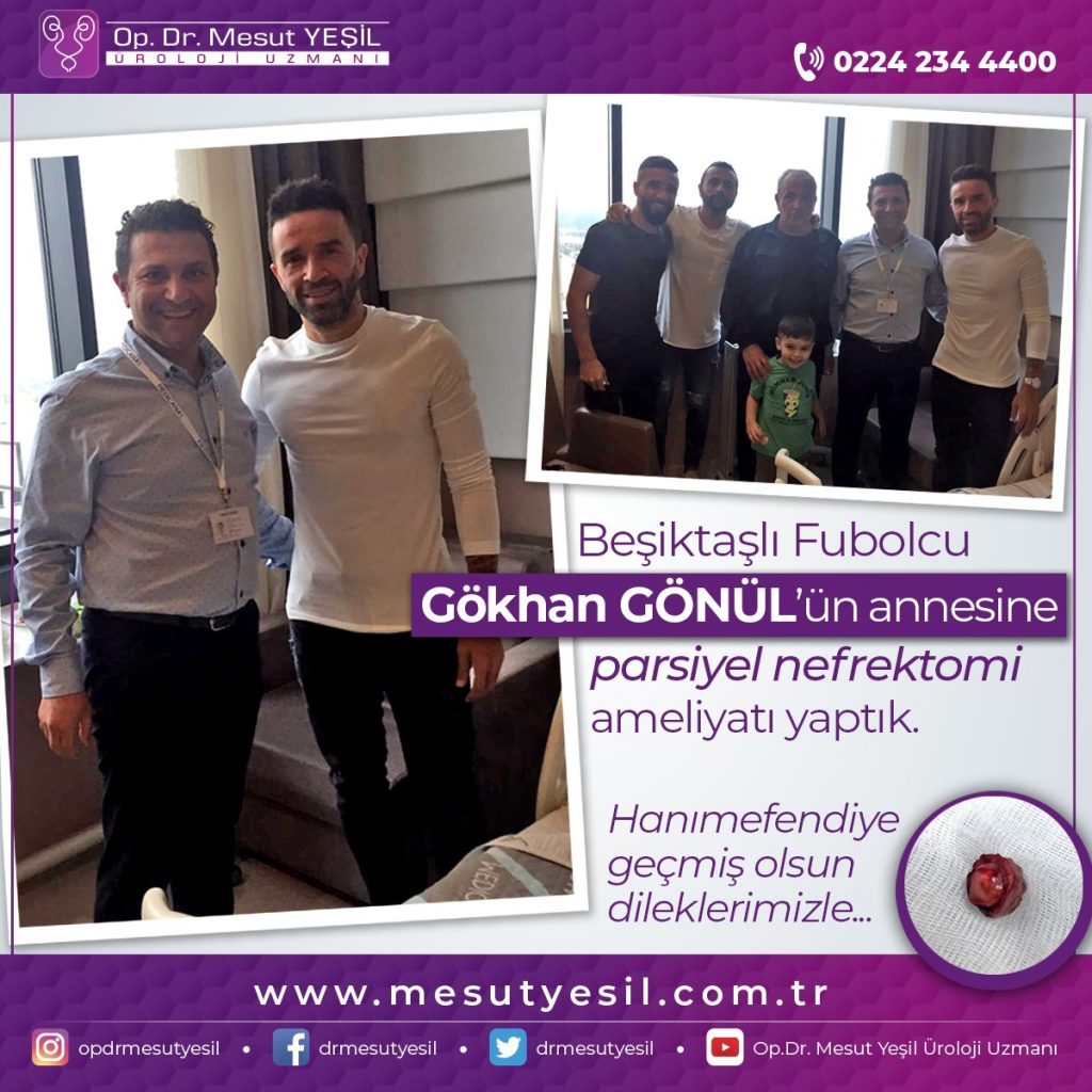 Beşiktaşlı Futbolcu Gökhan Gönül'ün annesine Laparaskopik Parsiyel Nefrektomi Ameliyatı yaptık.